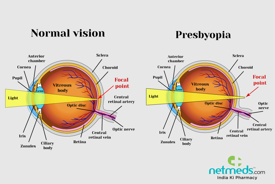 Presbyopia: Causes, Symptoms And Treatment