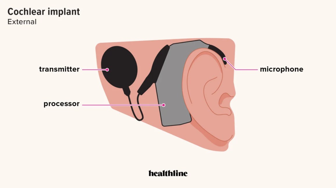 Cochlear Implant: Cost, Pros, Cons, Risks, How It Works