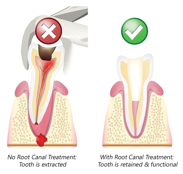 Saving Your Natural Tooth Vs. Extraction